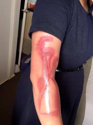 Um novo incidente envolvendo o iPhone 7 deixou sua usuária com queimaduras de segundo grau. (Foto: Divulgação)